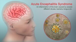 Japanese Encephalitis in Assam: Understanding the Rising Trends and Risks